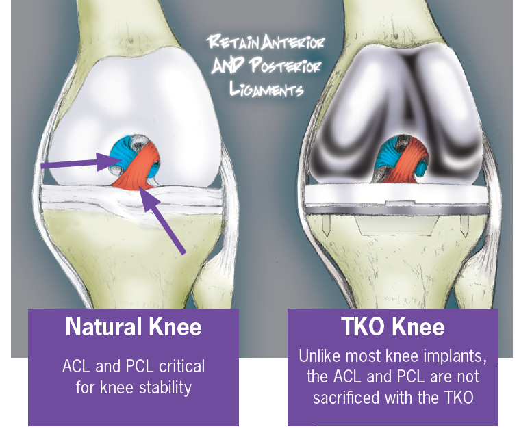 total-knee-system-bioproimplants