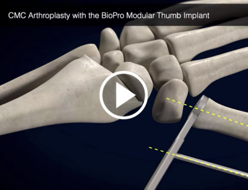 CMC Arthroplasty with the Modular Thumb Implant Animation