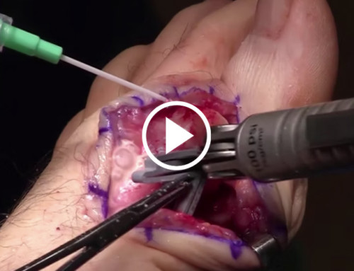 Youngswick Osteotomy Procedure with the Accu-Cut Osteotomy Guide System