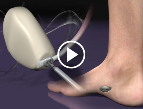 Kidner and Haglunds with the Tendon Anchor System Animation