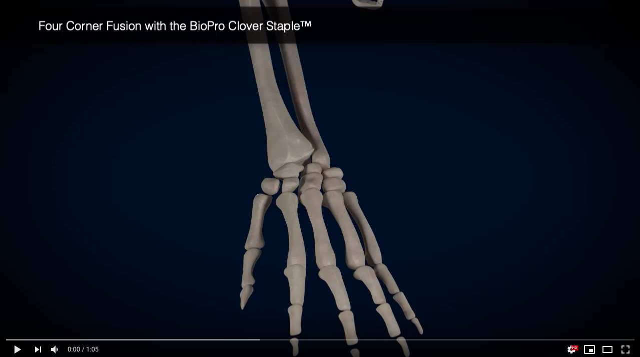 4-corner Fusion With The Clover Staple (animation) - Bioproimplants.com