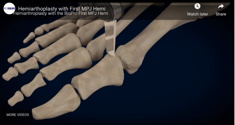 First MPJ Hemiarthoplasty with First MPJ Hemi (animation ...