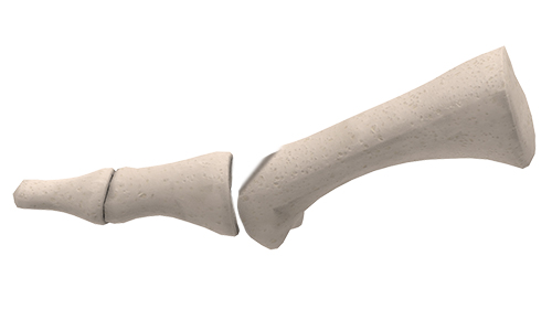 Cheilectomy Treatment