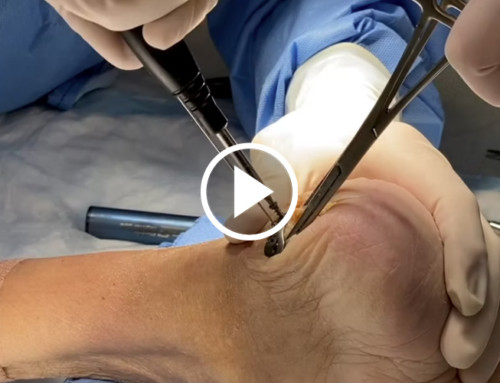 Haglunds Procedure with Tendon Anchor System