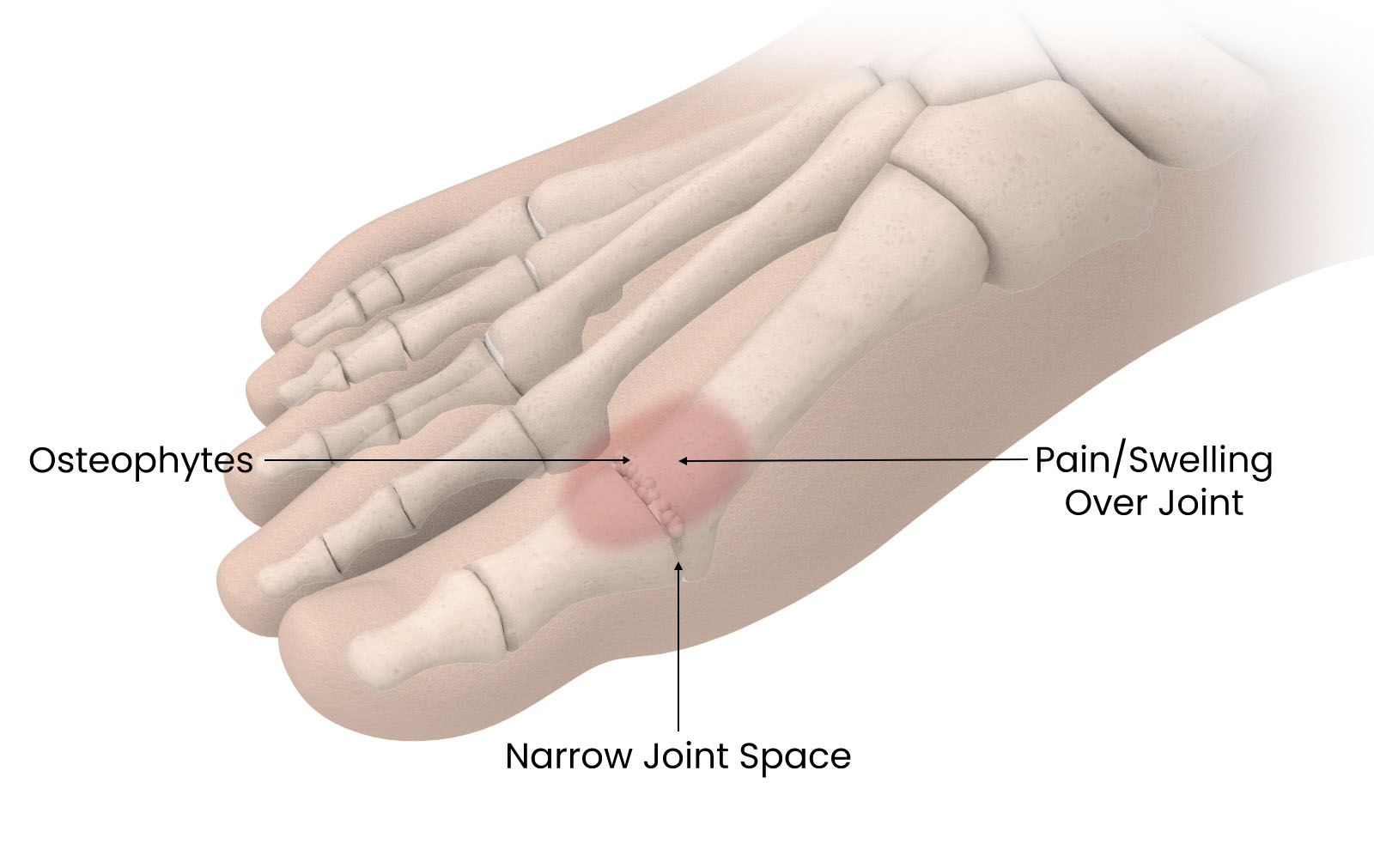 Most common causes of big toe pain 
