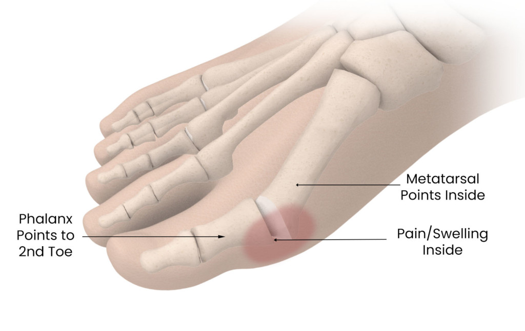 Most Common Causes Of Big Toe Pain - Bioproimplants.com