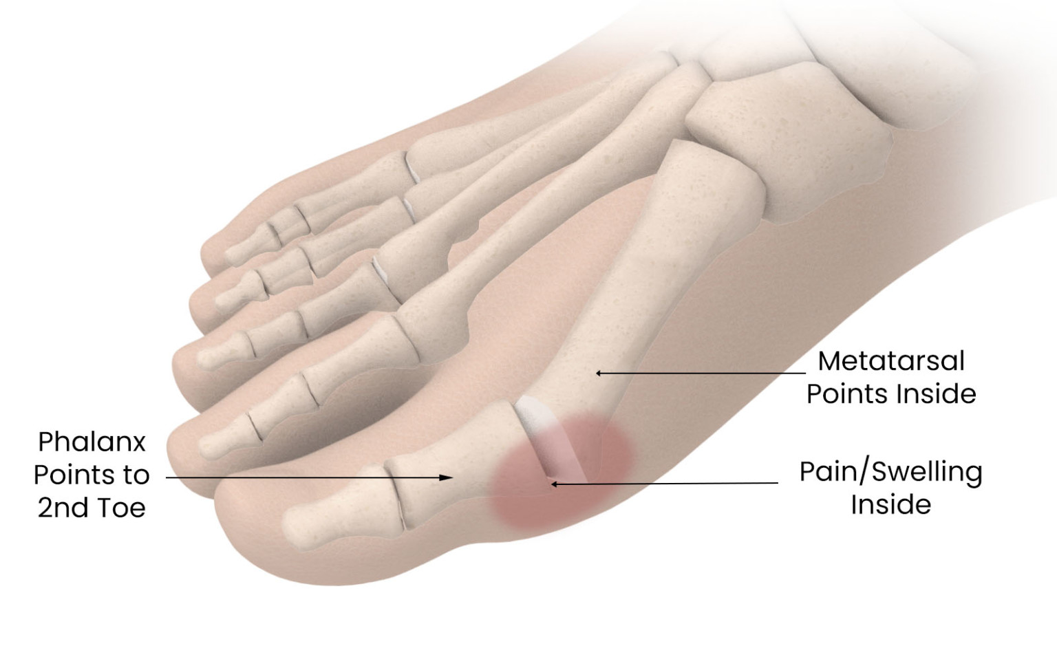 Most common causes of big toe pain - bioproimplants.com