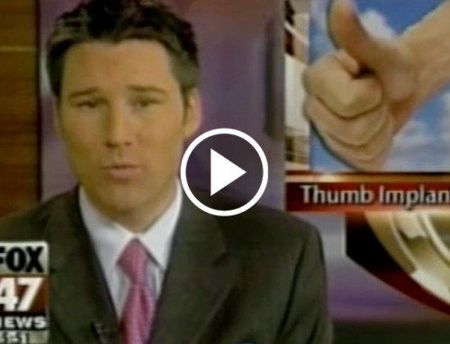 Modular Thumb Patient on Fox News