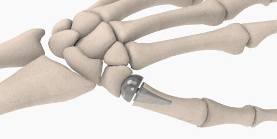 Hand and Wrist - bioproimplants.com