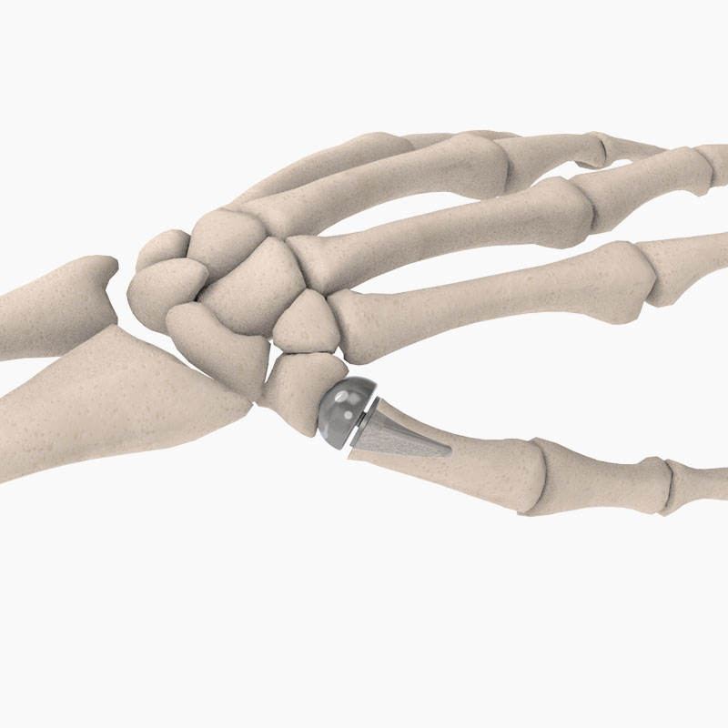 The BioPro Modular Thumb Implant: A New Look at a Proven Procedure ...