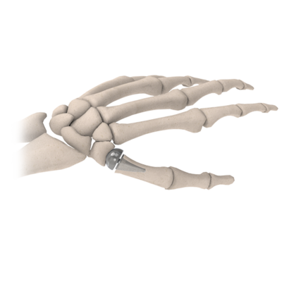 CMC Joint Replacement - The BioPro Modular Thumb Implant