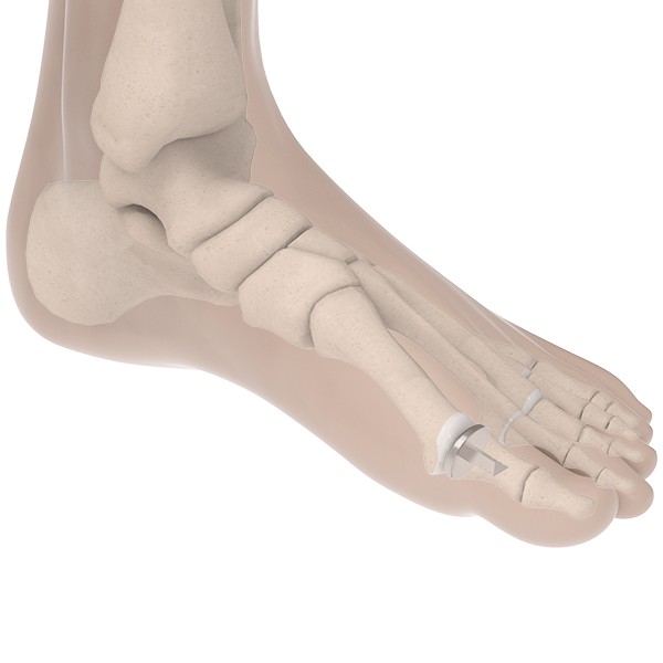 BioPro Hemi Toe Implant For Hallux Rigidus (Osteoarthritis)