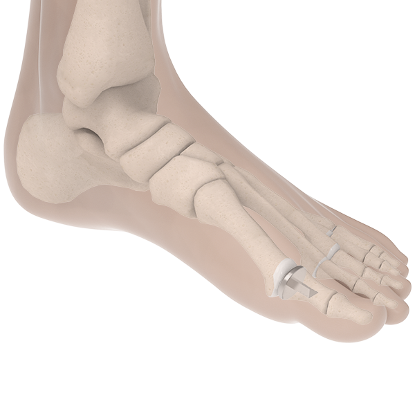 Ankle & Foot Physical Therapy, Biofix