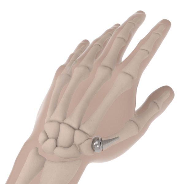 Thumb Arthritis Bioproimplants